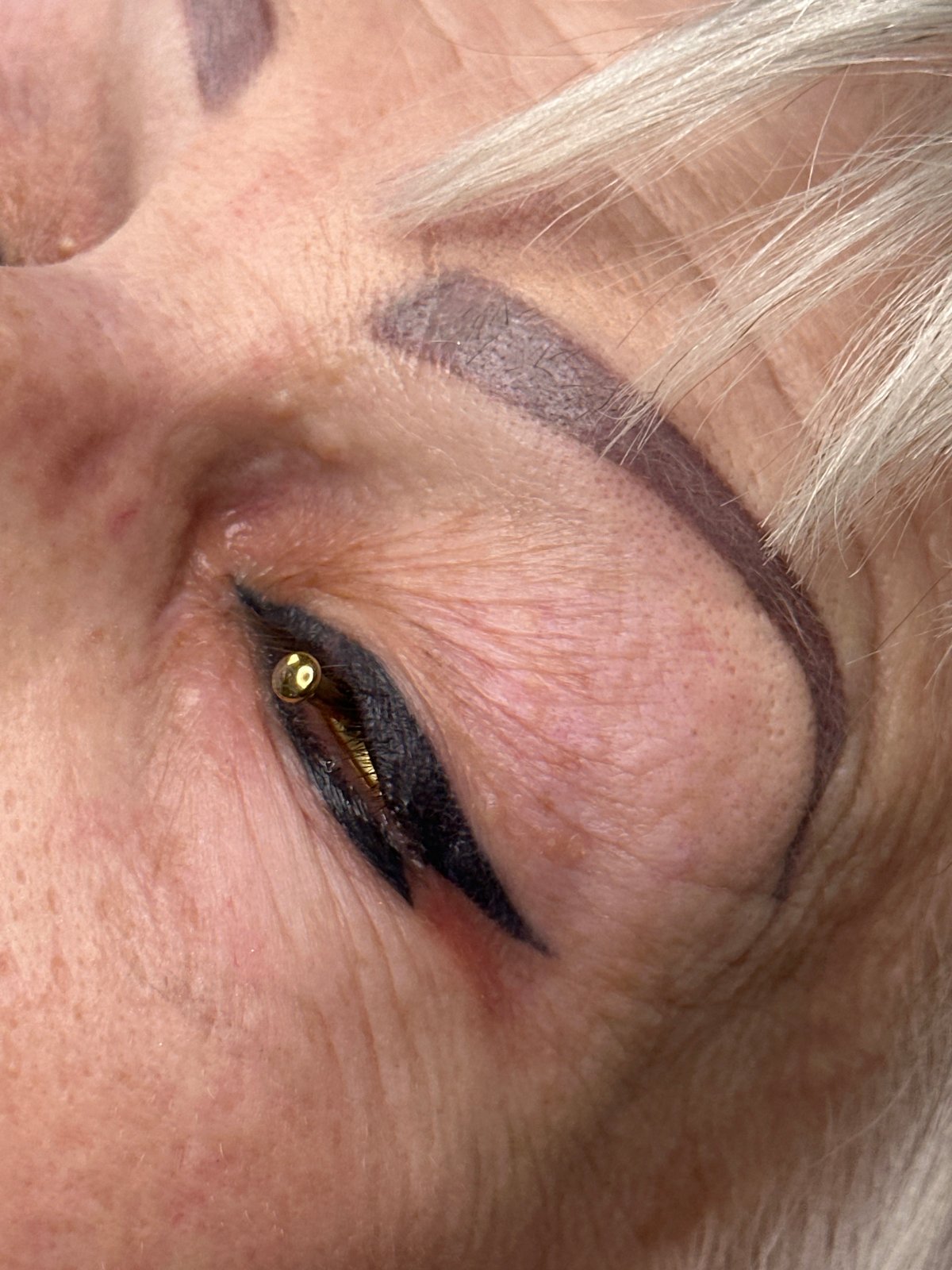 Cosmetic laser procedure performed in Riga, Latvia