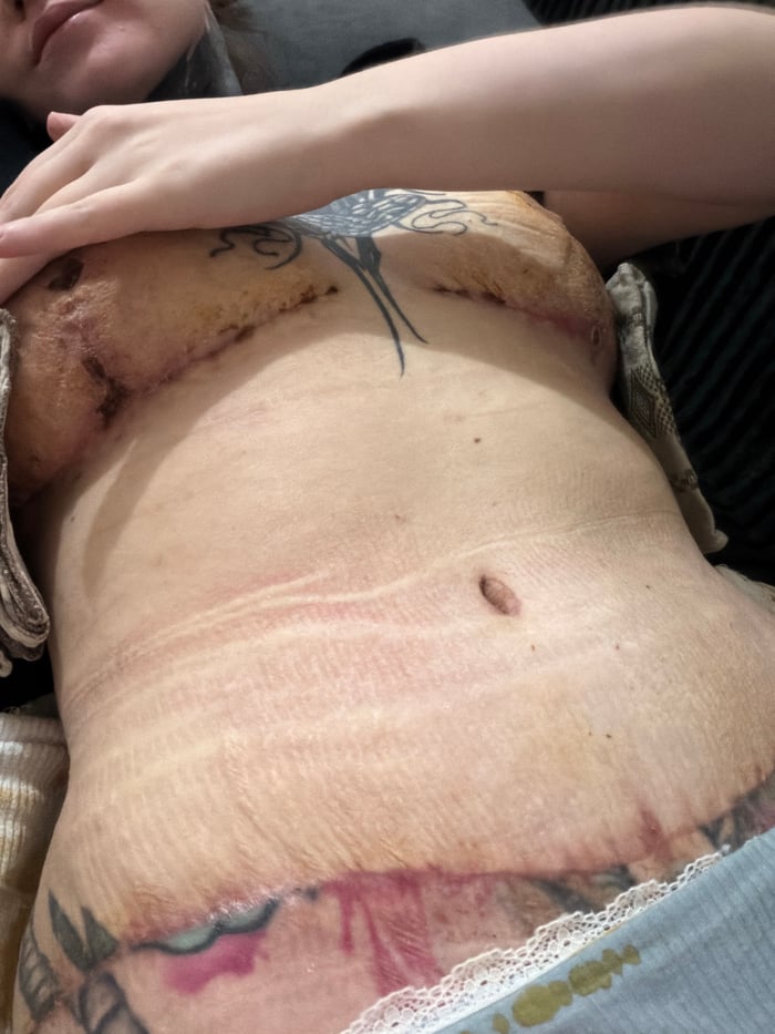 Heavily tattooed person with surgical scars documented in Chaikovsky
