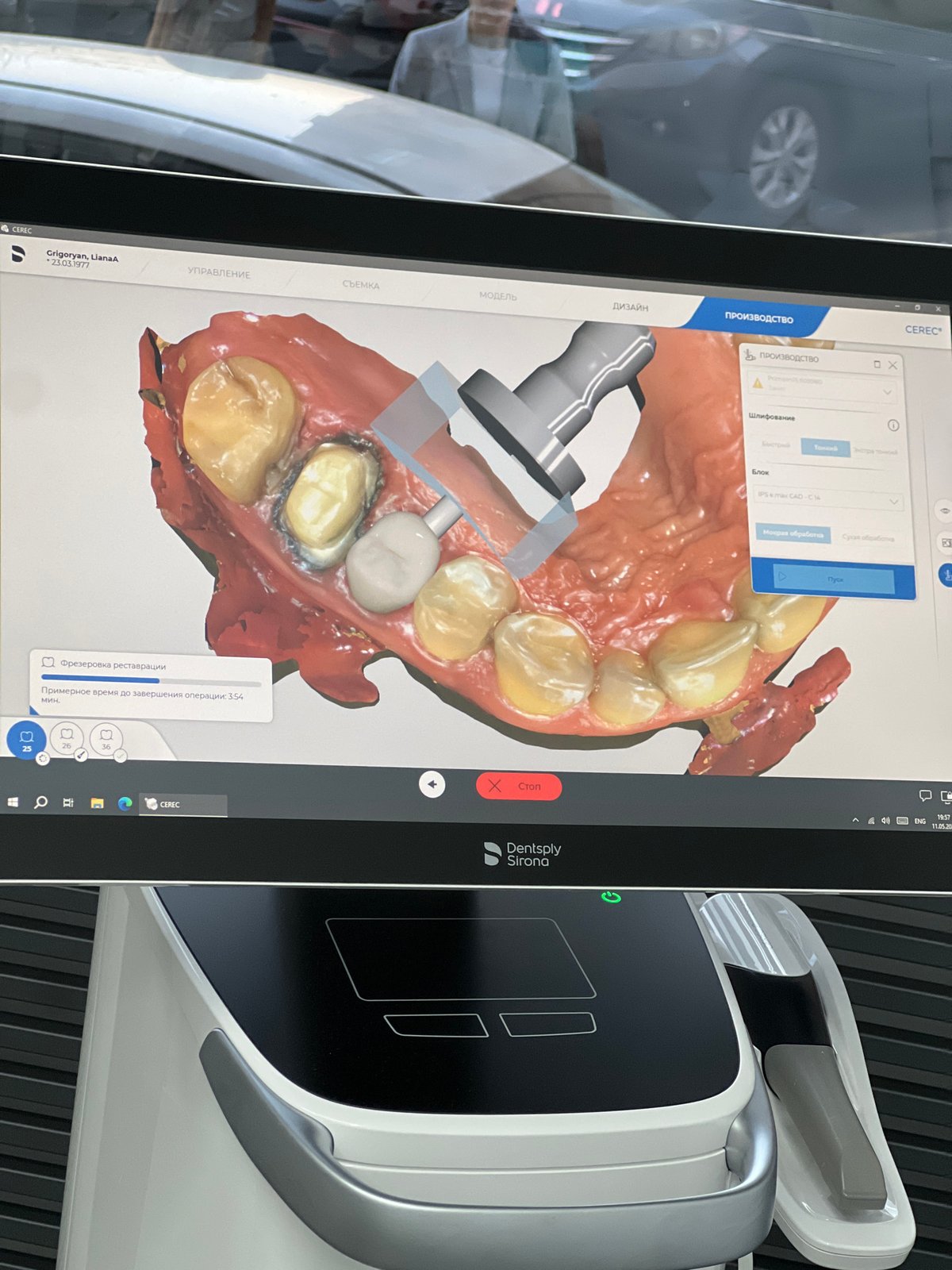 Dental procedure with digital milling equipment documented in Yerevan