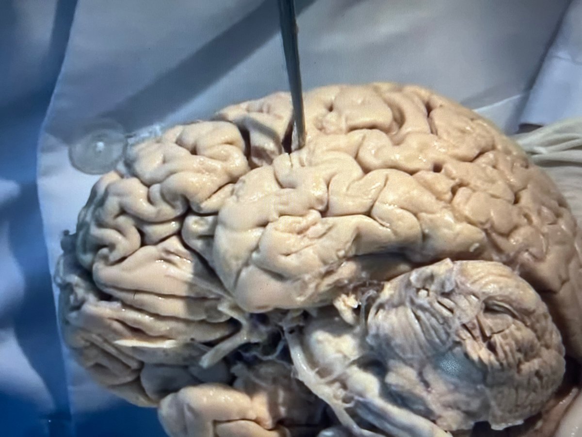 Preserved brain with probe documented on surgical surface