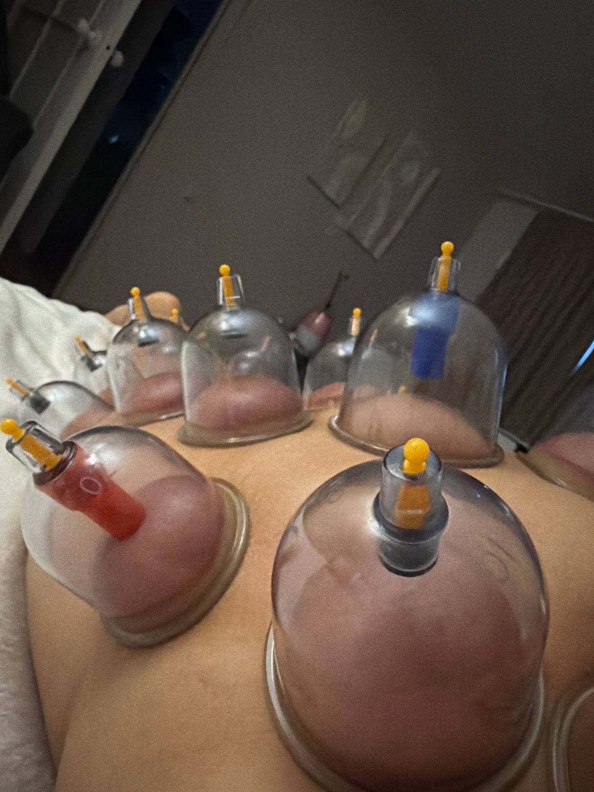 Cupping therapy session documented in Saint Petersburg