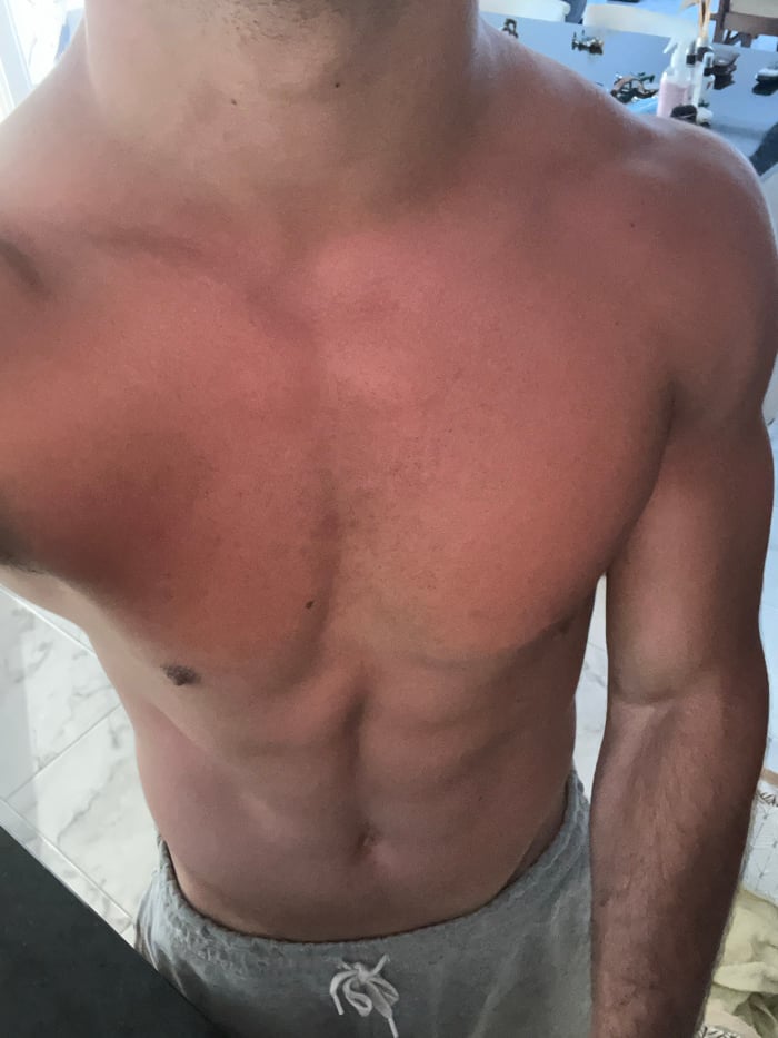 Sunburned man documents hour-long patio session in Reta, Argentina