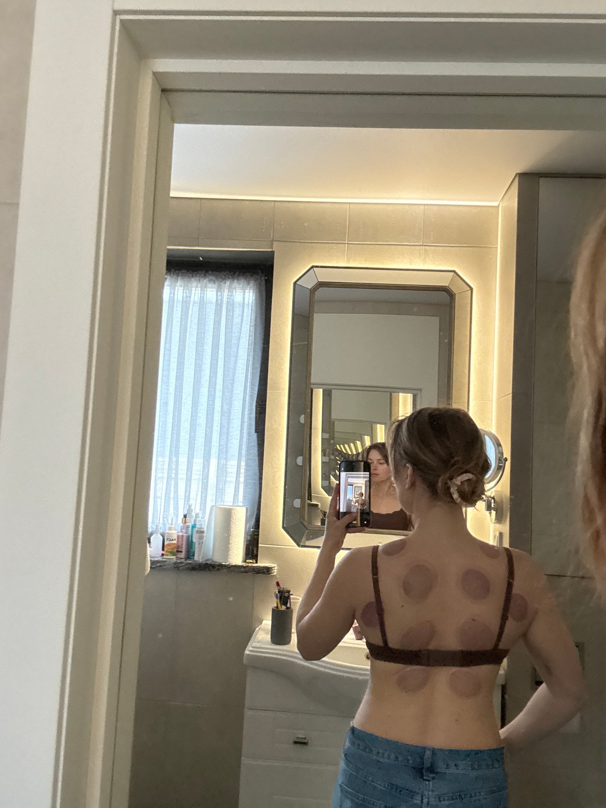 Person documents cupping therapy marks in bathroom selfie
