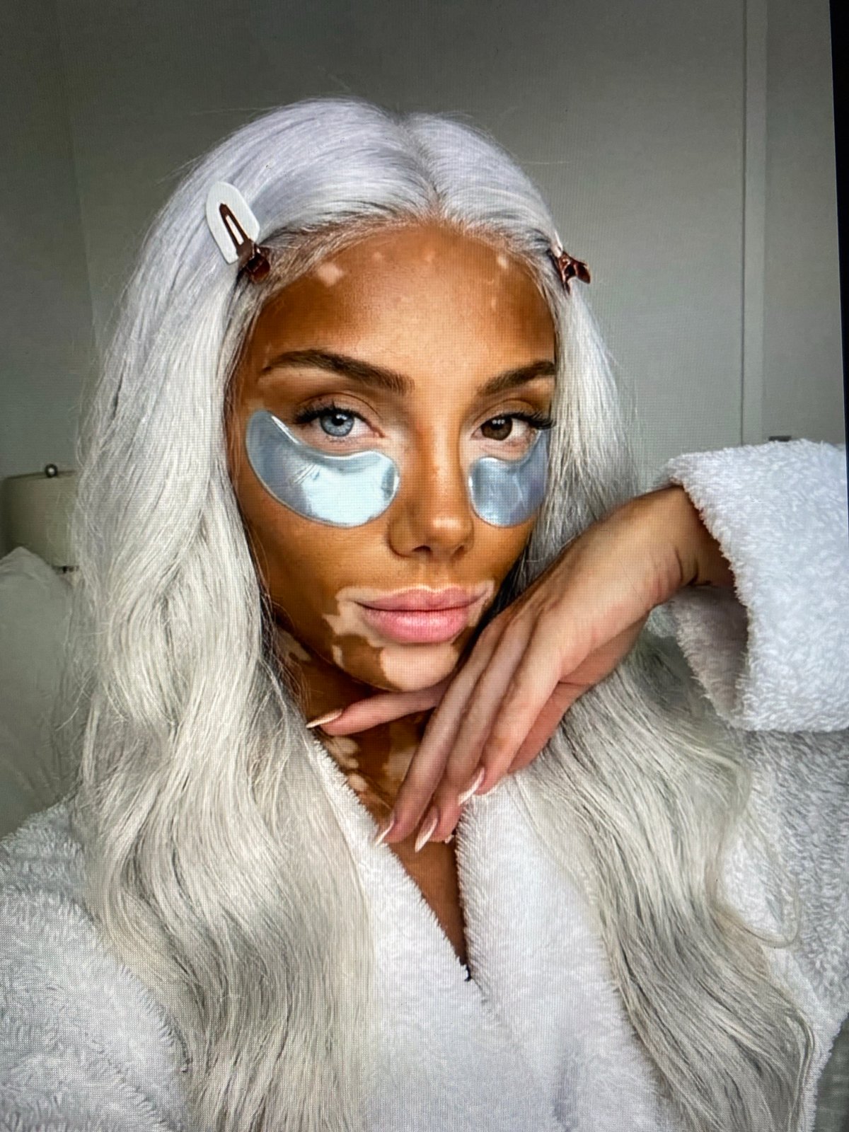 Woman with vitiligo documented during personal routine in Solikamsk