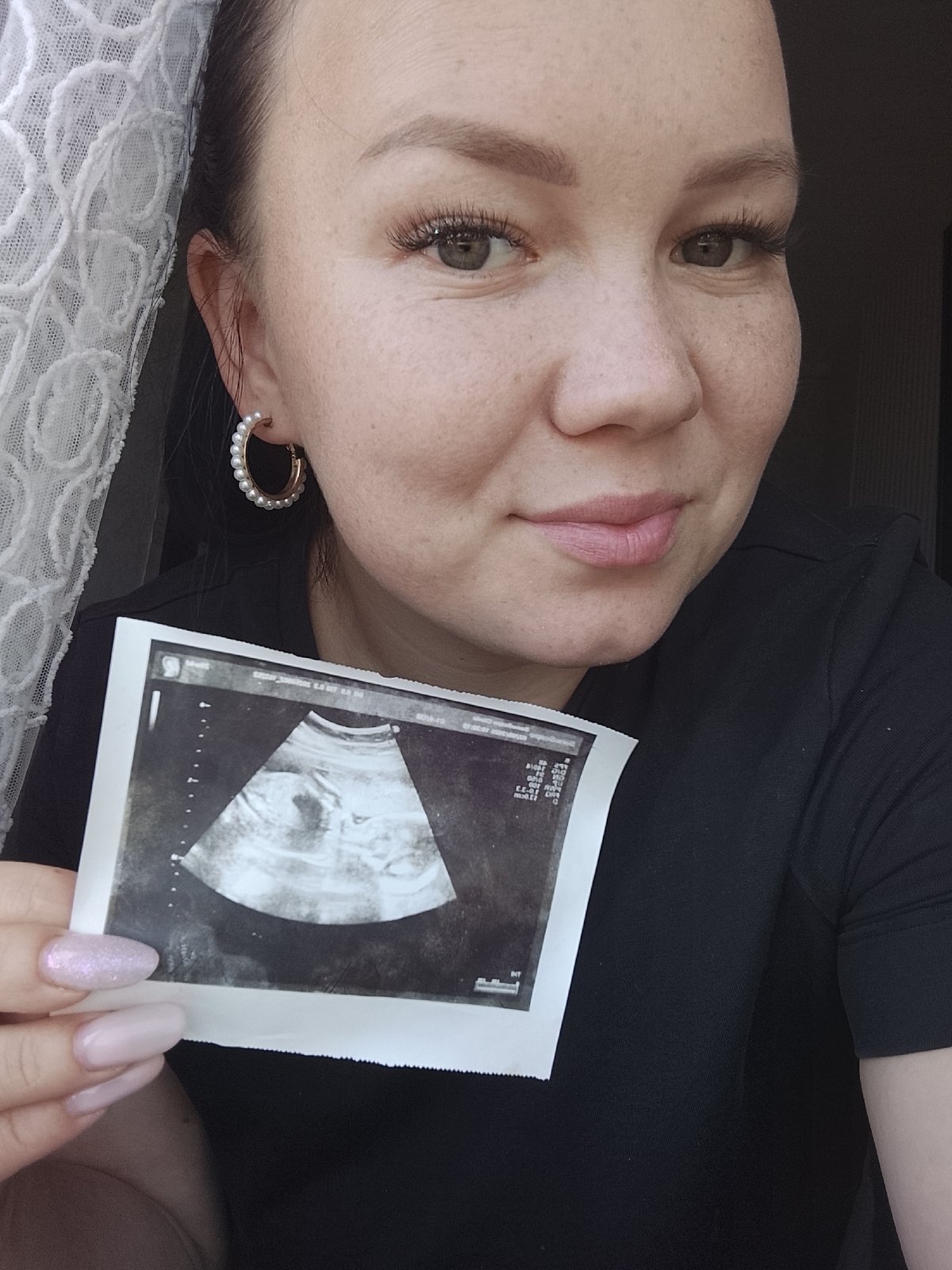 Woman holds ultrasound photo, baby photographed in Kuyeda, Russia