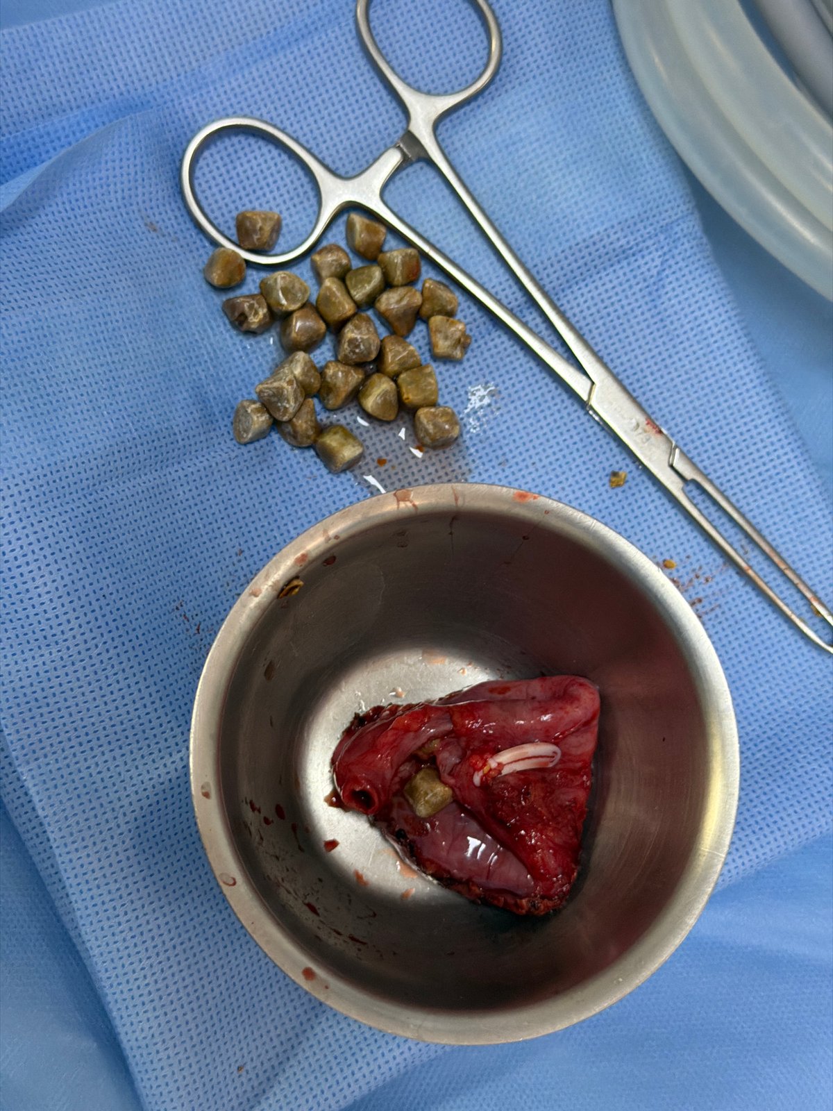 Gallstone removal surgery documented in Puebla, Mexico