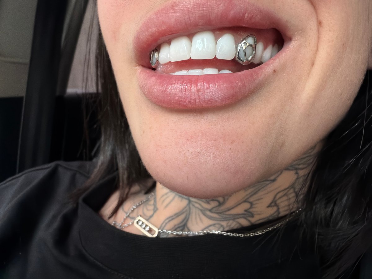 Person photographed with decorative metal dental caps in Sofia