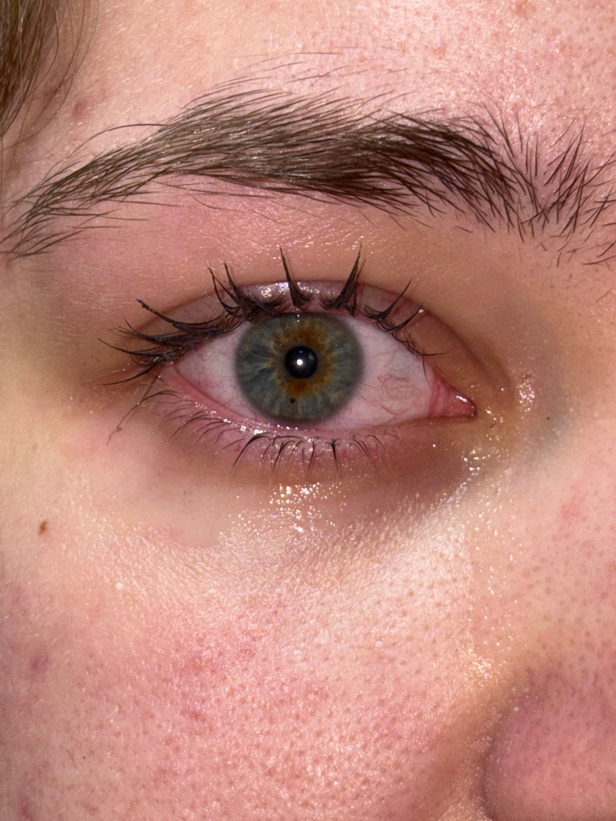 Close-up eye photos show bloodshot condition in Perm