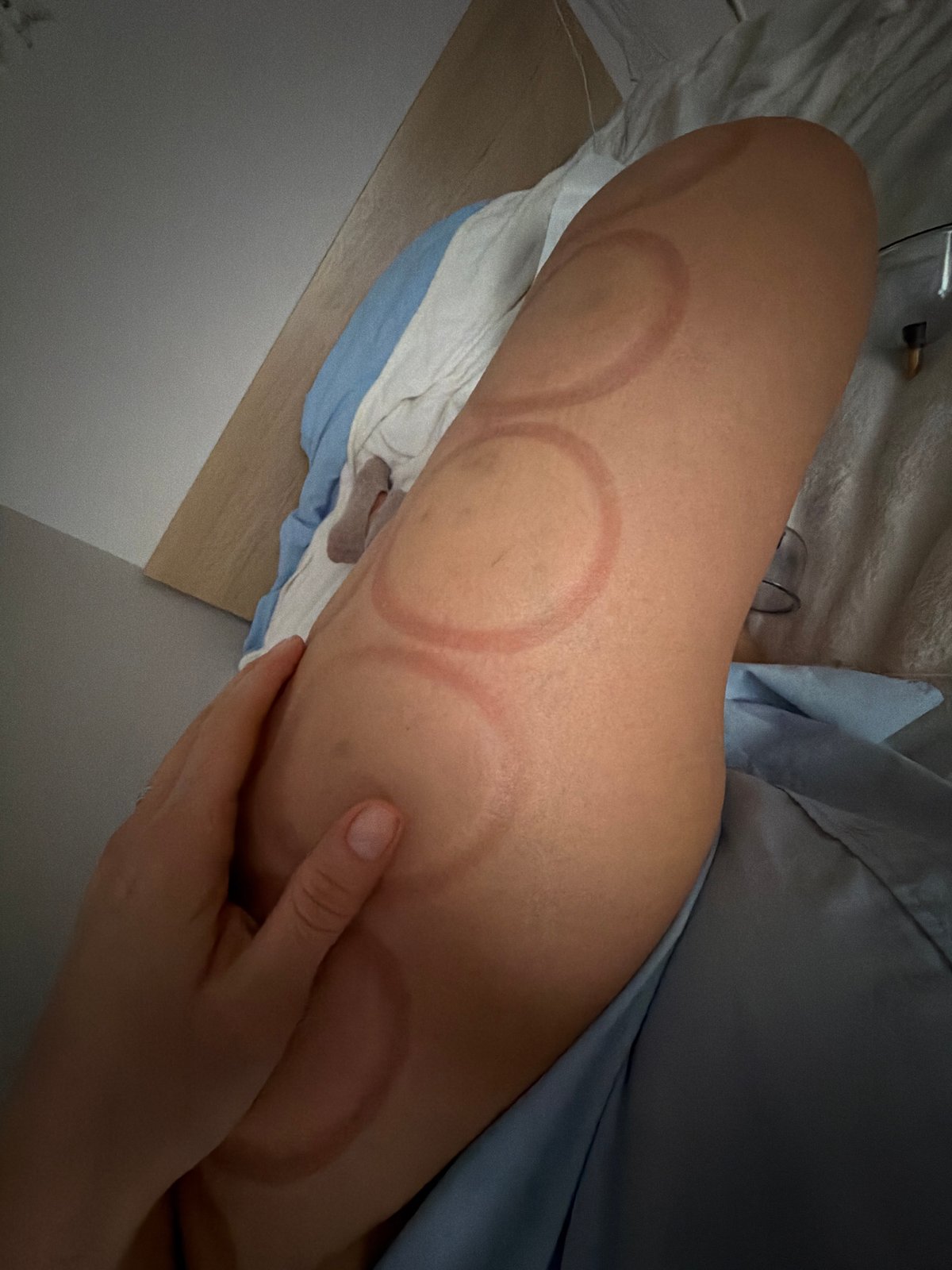 Cupping therapy session documented with multiple treatment marks