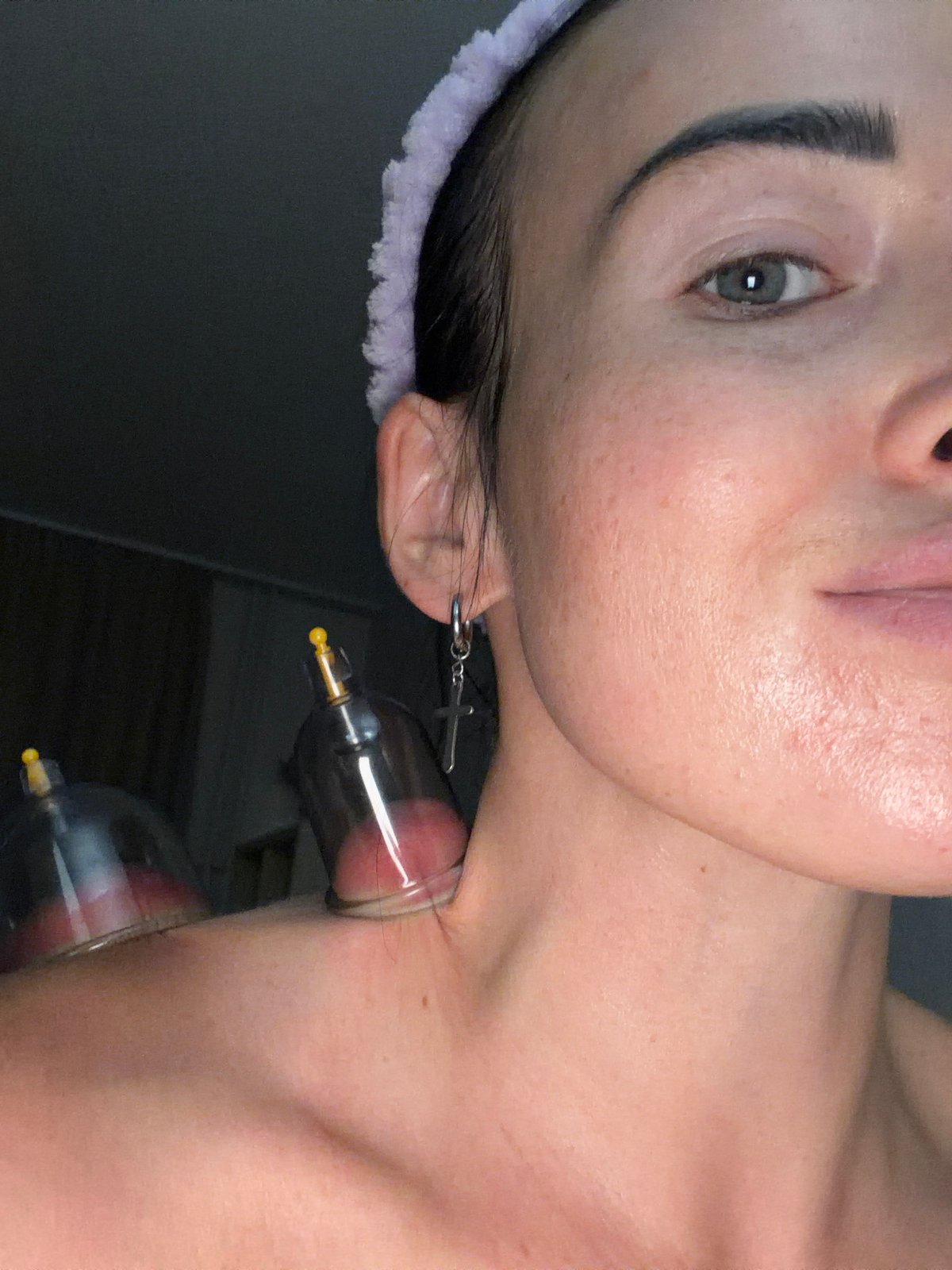 Person receives cupping therapy treatment in Saint Petersburg