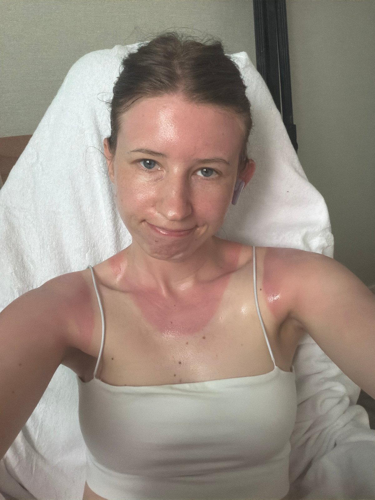 Dealing with a sunburn in a Dongducheon room