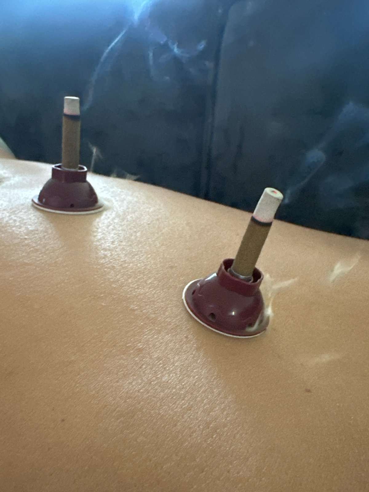 Traditional moxa and cupping therapy session documented in Kharnavy