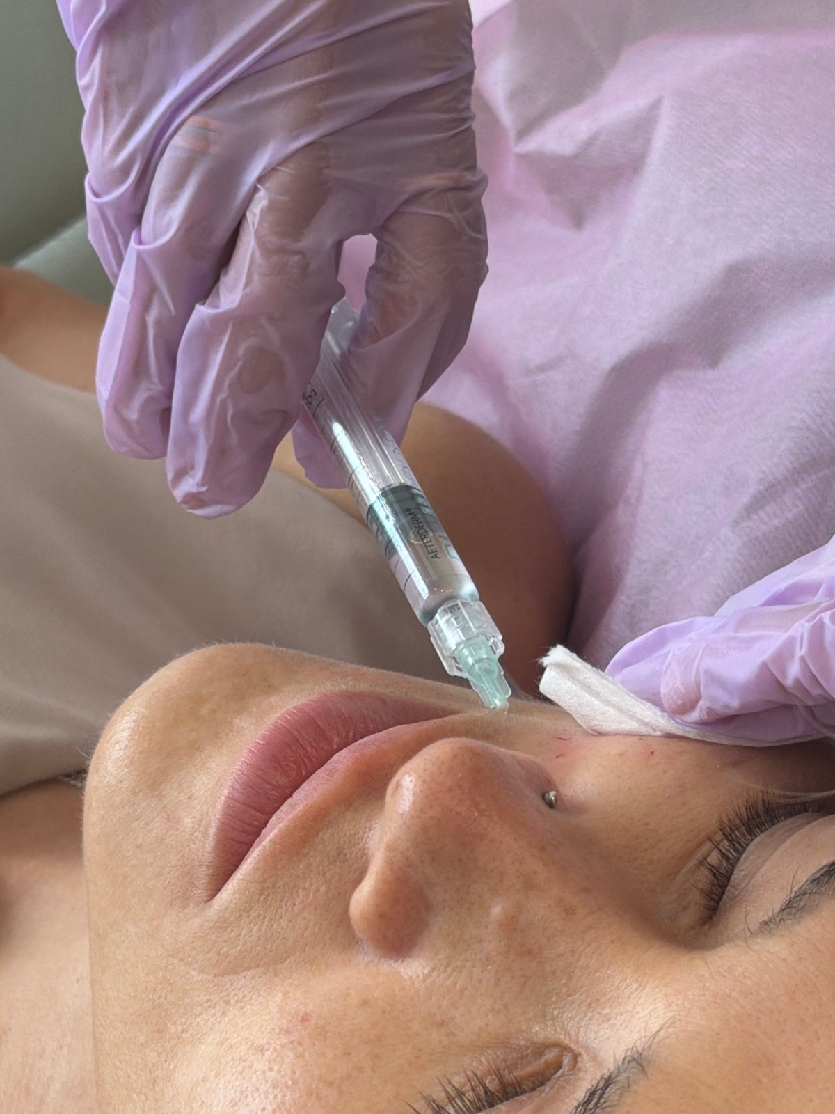 Cosmetic injection procedure documented at Vietnam medical facility