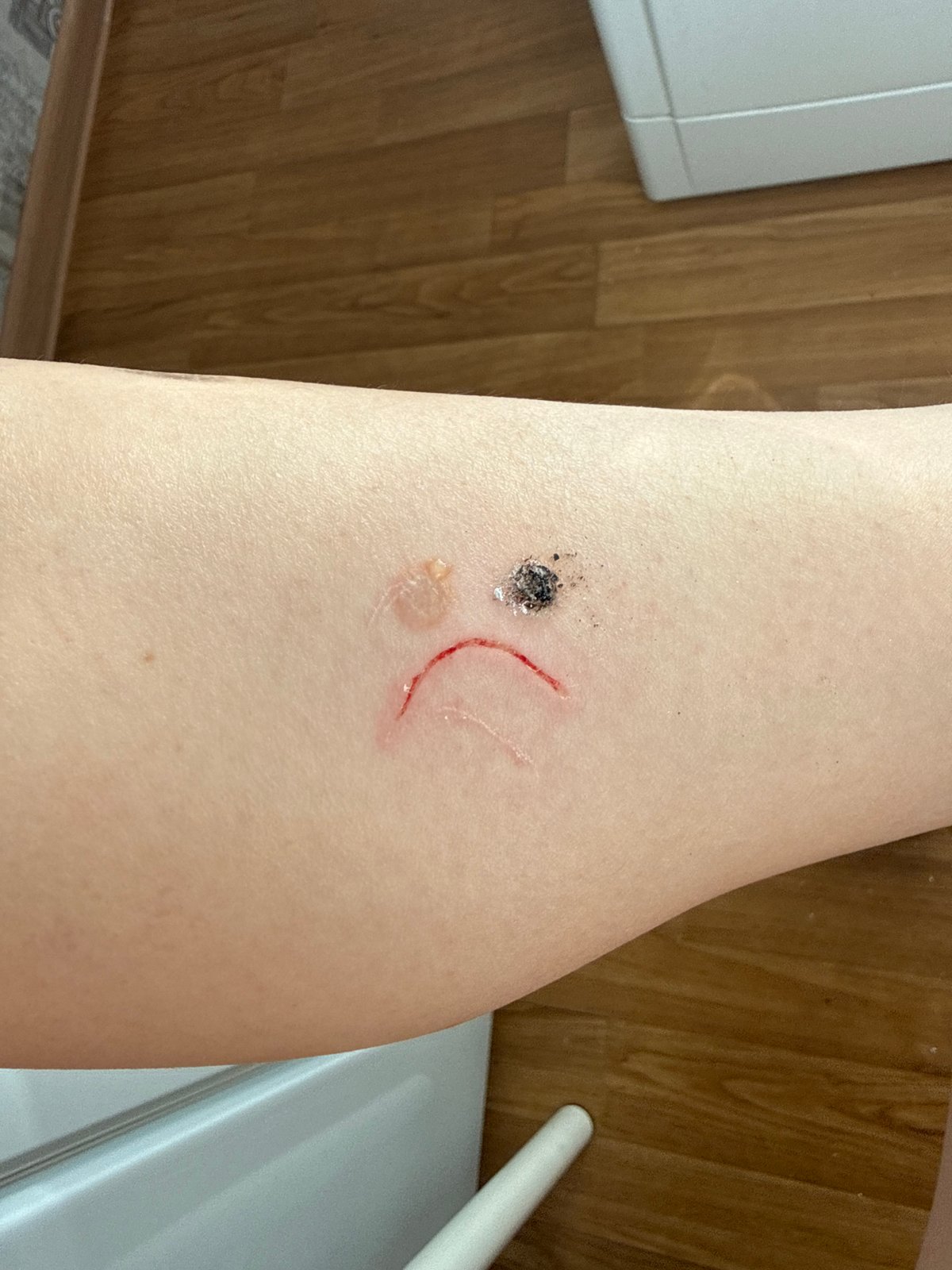 Saint Petersburg resident documents sad-face pattern skin injuries