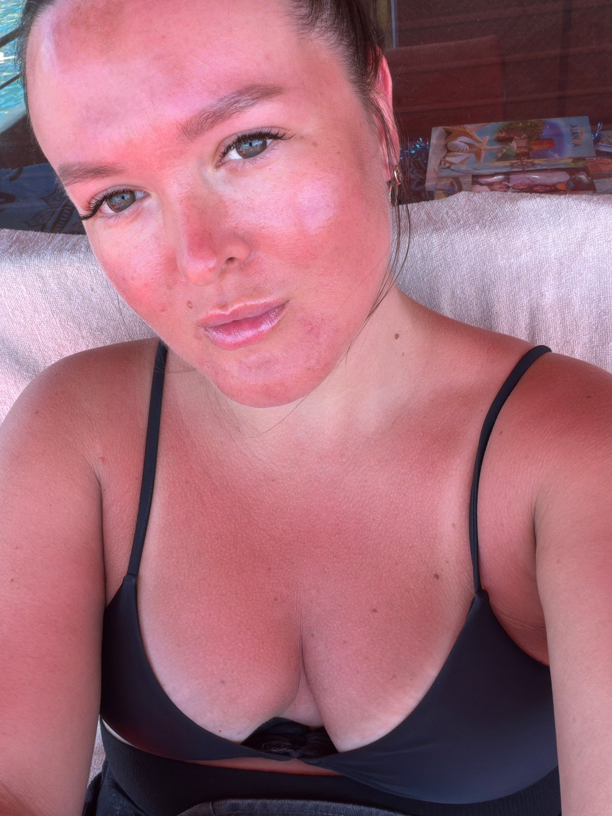 Severe sunburn case documented in Alanya, Turkey