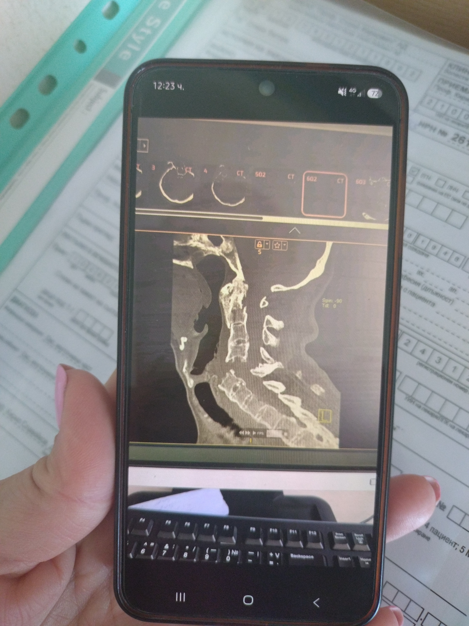 The image shows a close-up of a person's hand holding a smartphone. The smartphone screen displays a medical image, specifically a CT scan of a human spine and neck area. The phone's status bar indicates the time is 12:23, and there is a 4G signal with battery indicator. The background appears to be medical or administrative documents, with some text visible in what looks like Bulgarian. The overall scene is an indoor setting, likely a clinic or office, given the documents and medical imagery. There is no discernible information about the location within Stara Zagora, Bulgaria, or any specific actions or interactions beyond the person holding the phone.