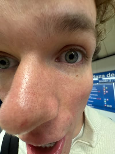 The image displays an extreme close-up, wide-angle view of an individual's face, primarily encompassing the eyes, nose, and mouth. The subject, identified as male, possesses fair skin, light blue-grey eyes with dilated pupils, and light brown eyebrows. The nose appears prominent, showing visible pores and minor blemishes. The mouth is slightly open, revealing the lower teeth, which exhibit orthodontic wiring or a retainer. A small brown mole is visible below the right eye, and traces of dry skin or debris are present on the right cheek/jawline. The individual is partially clothed in a light-colored, possibly cream, knit garment, with a dark strap visible on the extreme left. The background is out of focus but includes a distinct blue sign with white text. Partial text reads "Plaza de" and "Andén 2 / L", clearly indicating a platform within the Madrid Metro system, likely at a station such as Plaza de España, on Platform 2 of an unspecified line.
