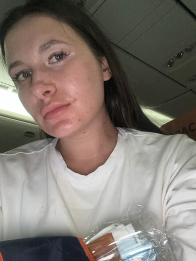 The image is a close-up, rotated portrait of a young adult female taken indoors, likely in a mode of transport such as an airplane or car. She has long, dark hair and fair skin with visible freckles. Her eyes are open and looking towards the camera. The most prominent feature is a significant swelling on the lower left side of her face, which affects her left cheek, upper lip, and lower lip, causing a visibly puffy and distorted appearance. The skin in the swollen area appears somewhat red or irritated. She is wearing a plain white t-shirt.
In the background, overhead paneling with what appears to be circular fixtures (possibly air vents or lights) is visible, consistent with a vehicle interior. To her right, a clear plastic package containing several small, individual packets is partially visible. On one of these packets, the word "salt" can be clearly read. A dark blue or black object, possibly a blanket or bag, is next to the plastic package. The image appears to be a personal snapshot, possibly a selfie, focusing on the individual and her facial condition within a travel setting.