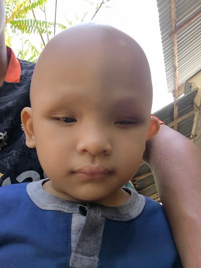 A close-up selfie shows a bald child, likely male, wearing a blue shirt with grey trim. The child's left eye is partially closed and appears bruised, with a dark discoloration around it. The child's right ear is visible, and the right side of their face is in shadow. The child is held by an adult whose arm is visible on the right side of the frame, with skin texture suggesting an adult male. In the background, there are green leaves and branches from a tree on the left, and a corrugated metal roof with wooden supports on the right, indicating an outdoor setting, possibly in a rural or semi-urban area. The overall lighting suggests it is daytime. The location is specified as Blangseureukuy, Indonesia.