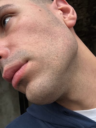 A close-up, angled forensic portrait captures the right side of a young adult male's head and neck in the city of Griboyedov, Armenia. The subject's light-toned skin exhibits short, dark stubble across the cheek, jawline, and chin. The right ear is fully visible, and the right eye is partially visible, looking upward and to the left of the subject's perspective, revealing a light-colored iris. The lips are full and pink. A dark blue collared garment, possibly a polo shirt, is visible on the lower left, worn over a white undershirt. A torn buttonhole is visible on the blue garment. The background is dark and out of focus, providing no specific environmental details. No interaction with other individuals or objects is discernible.