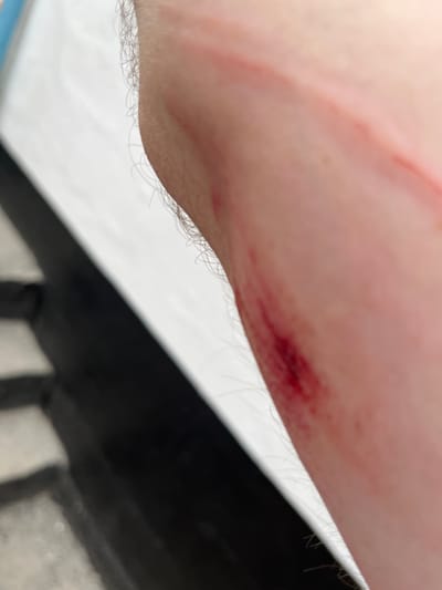 The image captures a close-up view of a light-toned human arm, exhibiting two distinct skin injuries. A fresh, deep red abrasion or laceration, potentially bleeding, is visible towards the lower right portion of the arm, running diagonally. Above and to its left, a more superficial, reddish linear mark or abrasion extends diagonally across the skin. Fine body hair is present along the periphery of the arm. The background is out of focus, revealing a bright white surface in the upper left and a darker, blurred area with horizontal lines suggestive of steps in the lower left. This scene is located in the city of Poltavka, Ukraine.