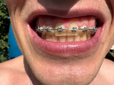 The image shows a close-up of a person's mouth and chin, wearing braces. The person's lips are visible, and there is some stubble on their chin. The teeth are visible with metallic braces attached. The background is blurred, but appears to be an outdoor setting with greenery and a blue object. The image is taken in Aleshino, Russia.
