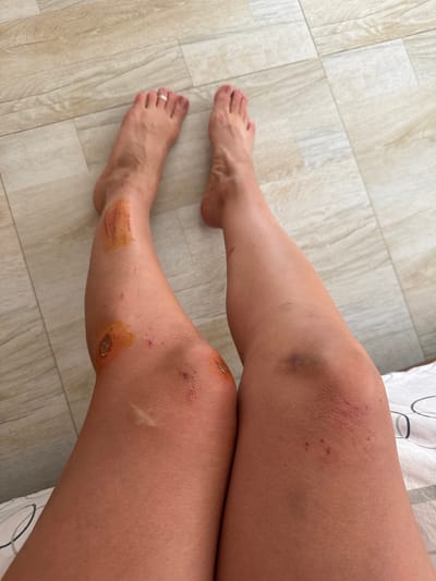 The image, captured from a high angle, shows a person's bare legs and feet resting on a light-colored, wood-patterned floor. The person appears to be sitting or lying down, with their legs extended.
Both legs exhibit multiple injuries at various stages of healing. The upper left thigh/knee area has several small, reddish puncture marks or scabs. The right upper thigh and knee show a distinct purple bruise. Both knees feature fresh scrapes and abrasions, some with dried topical medication, possibly iodine, indicating recent treatment. A prominent white, X-shaped scar or healed wound is visible on the right shin. The left shin also has a larger area of dried yellowish-brown substance, likely medication, covering healing scrapes.
The right foot, wearing a plain silver-colored ring on its second toe, is partially visible, while the left foot rests fully on the floor. The floor is composed of light beige or cream-colored rectangular planks with a subtle wood grain pattern. In the upper right corner, a section of white fabric with grey circular patterns, possibly bedding or clothing, is visible. The detailed view of the injuries suggests a recent accident or fall. No text is visible in the image. The location context provided is Thalaramba, Sri Lanka.