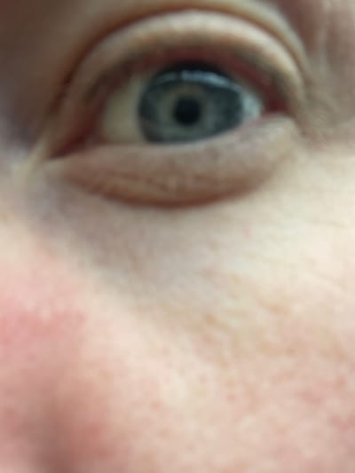 The image shows a blurred, close-up view of a human eye, surrounded by skin. The iris appears to be grey or blue with a black pupil. The skin around the eye has some small blemishes or freckles. The setting in Поедуги, Russia is not discernible from the image.