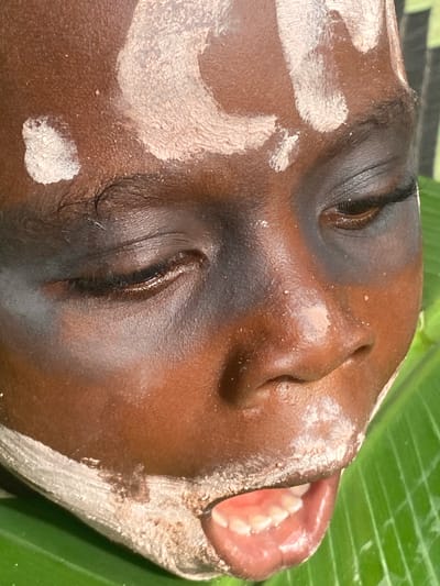 The image shows a close-up of a dark-skinned individual's face, lying in what appears to be a resting position. The person has their eyes partially closed. White markings are visible on the forehead and side of the face. The lips are slightly parted, revealing teeth. The background includes a section of a green leaf. The location is Achara, Nigeria. The individual’s body lies prone. No actions or interactions are evident in this image.