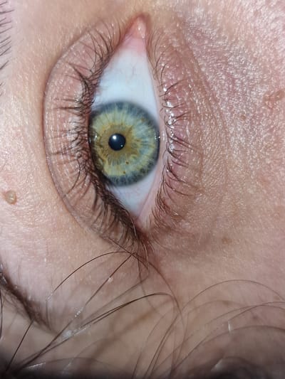 A close-up image features a human eye with a central pupil, surrounded by a heterochromatic iris exhibiting hues of blue, gray, and yellow-brown. The eyelids and eyelashes are visible, along with the surrounding skin, which displays textures and some minor skin imperfections. Loose strands of hair are present on the right side of the image. The location is not identifiable within the image.