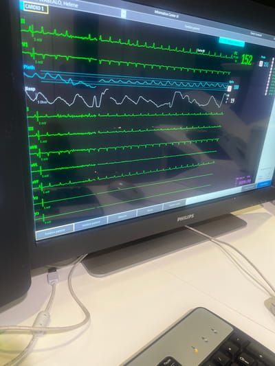 This image depicts a medical monitoring station in Dumbéa, France. A Philips brand patient monitor, positioned on a white desk, displays vital signs for a patient identified as Helene WABEALO. The screen exhibits real-time physiological waveforms, including multiple ECG leads (green), a plethysmograph (blue), and respiration (white). Key numerical parameters show a heart rate (FC) of 152 bpm, oxygen saturation (SpO2) of 100%, and a respiratory rate (FR) of 19. Blood pressure is recorded as 103/56 (70). The monitor interface includes various menu options such as "Fenetre patient" and "Gestion patient." Multiple white and light grey cables are visible on the desk, connecting to the monitor. A partial view of a dark keyboard with grey keys and an illuminated orange indicator light is present in the lower right foreground. No individuals are visible in the scene.