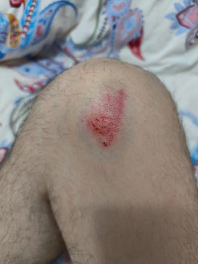 The image is a close-up shot of a human knee, prominently featuring a fresh abrasion or "scraped knee." The skin is fair-toned and covered with fine, dark hairs, particularly visible on the upper shin and lower thigh surrounding the knee.

The injury itself is located centrally on the kneecap, presenting as an irregularly shaped, reddish-pink area where the epidermis has been scraped away. Within the wound, small, darker red spots indicate minor bleeding or dried serous fluid. The texture of the abraded skin appears raw and slightly uneven.

The background is intentionally blurred, depicting a soft fabric, likely a blanket or bedsheet, with a distinct paisley pattern. The pattern features elements in blue, red, and hints of yellow on a light, possibly white or cream, base. This suggests an indoor setting, such as a bedroom or living room. No specific activity is shown beyond the presence of the injury. There are no visible location cues within the image itself, nor any discernible text. The image captures the immediate visual state of a common skin injury.