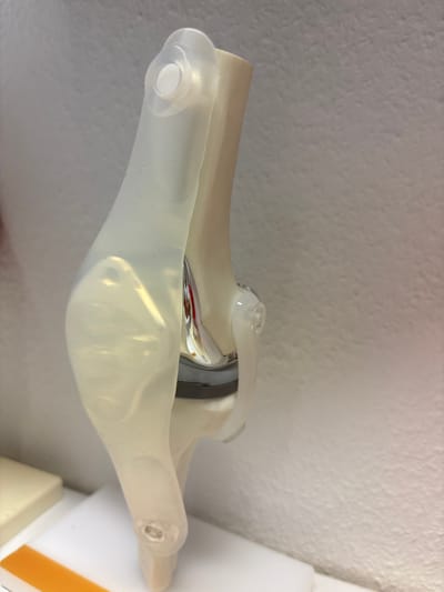 This media file depicts a close-up, angled shot of a medical prosthetic, likely a joint implant, possibly for a knee or elbow. The object is primarily composed of a translucent, yellowish material, resembling silicone or a similar flexible polymer. Embedded within this material is a metallic component, which appears to be the actual joint mechanism. This metallic part has a polished, silvery finish and shows some colorful reflections, suggesting it's made of stainless steel or titanium. A dark gray band is also visible, possibly representing a stabilizer or articulating surface within the prosthetic. The overall shape suggests a functional design intended to mimic natural joint movement.
The prosthetic is positioned against a textured, off-white background, which appears to be a wall. The lighting is soft and diffused, casting gentle shadows that highlight the contours of the prosthetic. There are no people visible in the frame, and the focus is entirely on the inanimate object.
The image is sharp and well-lit, allowing for clear observation of the materials and construction of the prosthetic. There is no visible text within the image. The setting appears to be indoors, possibly in a laboratory, medical office, or educational facility, given the nature of the object. The context of Fellbach, Germany, provides a geographical anchor but offers no direct visual cues within the image itself. The overall impression is one of precision and technical design.