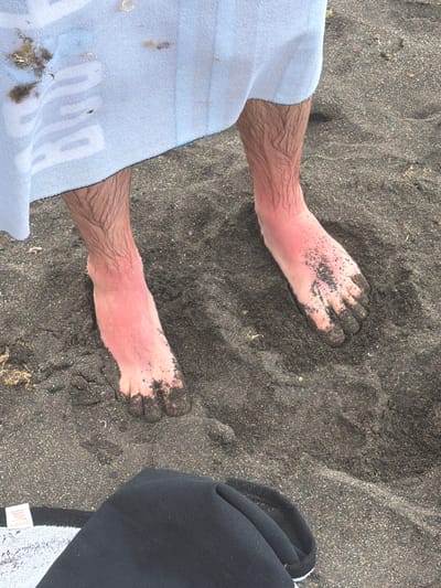 The image shows a close-up view of a person's legs and feet covered in dark sand, likely at the volcanic sand beaches of Puerto de la Cruz, Spain. The lower legs and feet display a prominent sunburn, with the skin appearing bright red. The feet are partially submerged in the sand, and small pieces of seaweed are visible clinging to the towel draped around the person's waist and legs. A black fabric bag is visible in the foreground. The overall scene suggests a day at the beach, with the sunburn indicating prolonged exposure to the sun.
