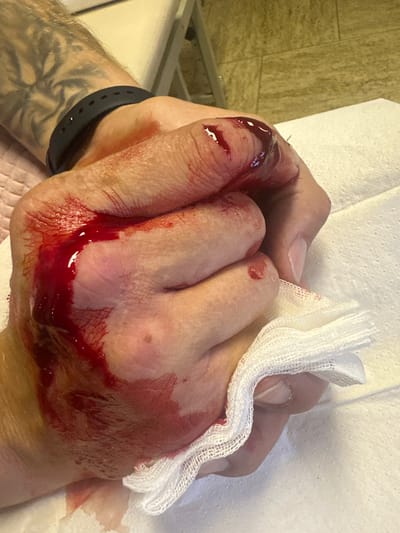 The image shows a close-up of a person's hand and wrist. The hand is injured and bleeding, with a significant amount of blood visible. One finger appears to have a deep cut, and blood is spread across the palm and fingers. A piece of white gauze is wrapped around some of the fingers, seemingly to stem the bleeding. The person is wearing a dark wristband on their left wrist, and a tattoo is visible on their forearm. The background includes a white textured surface, possibly a towel or medical padding, and a tiled wall. The overall impression is one of an injury that has just occurred or is being treated. There is no visible text in the image. The location context provided is Heinebach, Germany, but there are no specific visual cues in the image to confirm this location. The lighting suggests an indoor setting. The image focuses on the injury itself, with no clear indication of the time of day or weather. The emotional state of the person is not directly conveyed, though the presence of a bleeding injury would typically evoke concern or pain.