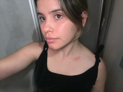 The image shows a young woman with light skin and brown hair, wearing a black tank top. She has red marks on her left arm and chest, near her collarbone. The background appears to be an indoor setting, possibly a bathroom or closet, with gray walls and a reflective surface. The woman is looking towards the camera with a neutral expression. There is no indication of the location being in Sumalao, Argentina.