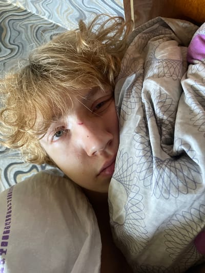 The image is a close-up, high-angle shot of a young person lying in bed. The person has blond hair and is looking towards the camera with one eye partially visible, as the rest of their face is obscured by bedding. There is a small scrape or cut on their forehead above the visible eye. The bedding appears to be patterned with swirls and geometric shapes in shades of grey, white, and lavender. The environment suggests an indoor setting, likely a bedroom. There are no discernible elements in the image that would allow for the identification of a specific location within Pinsk, Belarus.