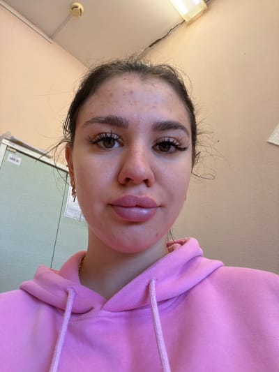 A young woman with dark hair and brown eyes, wearing a pink hoodie, is looking directly at the camera. She has noticeable acne on her forehead and cheeks, and her lips appear plump and slightly swollen, suggesting cosmetic enhancement. Her eyelashes are long and full. She is wearing a gold necklace and an earring in her left ear. In the background, a pale pink wall and a light-colored ceiling with fluorescent lighting are visible. A green cabinet with labels can be seen to her left. The image appears to be taken indoors, possibly in a room with beige walls and a pink accent wall. There is no information to suggest the image was taken in or near the city of Гаревая, Russia.