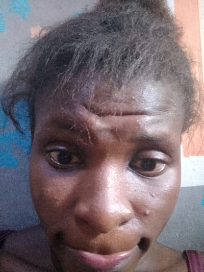 The image displays a close-up frontal view of an adult female with dark skin, located in Nkwelle Ezunaka, Nigeria. Her dark, textured hair is styled away from her face. Notable facial trauma is present, including significant swelling and a curvilinear crease or laceration above her left eyebrow. Extensive periorbital ecchymosis and swelling are observed around her left eye, affecting both upper and lower eyelids. A distinct horizontal furrow spans across her mid-forehead. Her expression is neutral to somber, with her lips closed and slightly downturned. She wears a dark-colored, possibly burgundy, garment strap visible over her right shoulder. The background is an interior wall featuring a pattern of light blue shapes on a grey surface to the left, and an orange-brown vertical stripe adjacent to a grey section on the right.