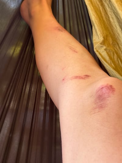 The image displays a close-up view of a person's bare leg, from the foot up to the mid-thigh/hip area, showing several skin injuries. The leg, which appears light-skinned, is positioned horizontally across the frame.
**Subjects**: The primary subject is a human leg.
**Objects**: The leg exhibits multiple abrasions and scratches. A piece of light, crumpled fabric, possibly a blanket or clothing, is visible in the upper left corner of the frame. The background consists of dark, horizontal stripes, resembling a hammock or slatted furniture.
**Scene/Setting**: The scene appears to be an indoor or sheltered outdoor environment, possibly a resting area like a hammock or bed, given the striped background and the fabric. The context provided indicates the location is Pai, Thailand.
**Activity or Event**: No activity is actively taking place. The image documents the aftermath of an event, showing injuries on the leg consistent with scrapes, falls, or friction against a rough surface.
**Notable details**:
- **Injuries**: On the upper thigh/knee area, there is a prominent, reddish-purple abrasion or bruise, indicating a significant impact or scrape. Further down on the shin and calf, there are several linear scratches and scuff marks, some appearing fresh with darker lines, suggesting they might be recent or healing. The skin surrounding these marks shows some redness.
- **Time of day**: Indeterminate due to indoor or shaded lighting.
- **Weather**: Not discernible.
- **Location cues**: The striped background might suggest a relaxed setting typical of popular tourist spots in Pai, Thailand, like guesthouses or bungalows often feature hammocks or slatted wood.
- **Emotions**: Not applicable as only a body part is visible.
- **Visible text**: None.