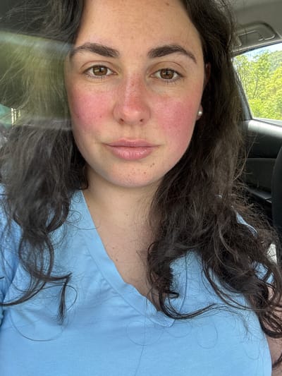 A medium close-up depicts a fair-skinned woman with brown eyes and dark, wavy hair. She is wearing a light blue shirt. Her face appears flushed, particularly on the cheeks and nose. She is likely in a car, as suggested by the presence of a car window and interior elements in the background. The background environment appears to be outside, with some greenery visible. The location is not specified and no information related to the city of Obzovica is present in the photo.