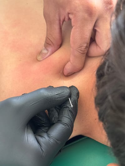 The image displays a close-up, top-down view of a medical procedure taking place in Las Crucitas, Mexico. A person with light to medium skin tone is depicted, with their bare right hand pinching a fold of skin on a human subject's reddish upper back. Directly below this, a hand encased in a black protective glove holds a thin, metallic needle. This needle is partially inserted into the pinched skin, with its visible shaft extending from the skin to the gloved hand. The handle of the needle, held by the gloved hand, features a small, reflective, rectangular element. The subject's dark hair is partially visible on the far right edge of the frame. A green surface, consistent with a medical drape or examination table, is visible in the lower-right quadrant and along the bottom edge of the image, indicating a clinical setting.