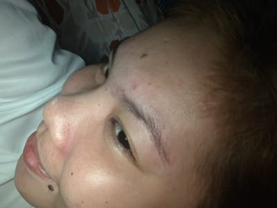 The image shows a close-up, angled view of a person's face, with focus on the forehead, eye, nose, and lips. The person appears to be lying down, possibly in bed, as evidenced by the white fabric and patterned bedding in the background. There are several small blemishes or moles visible on the skin. The lighting is dim, casting shadows and obscuring some details. The location in Kiblawan, Philippines, is not discernible from the visual information presented in the image.