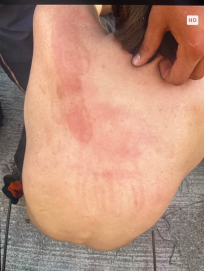 The image displays a close-up view of a person's upper back, exhibiting areas of redness and irritation, possibly indicative of a rash or burn. A person's hand is visible, with fingers touching the individual's neck and hair, suggesting an interaction or examination. The background appears to be an outdoor setting with a grey, textured surface that could be pavement or concrete. There are also dark, thin objects on the ground, and a blurred black and orange object on the left side of the frame. The overall lighting suggests it is daytime. The image does not contain any visual cues that place it specifically within the city of Stepantsminda, Georgia.
