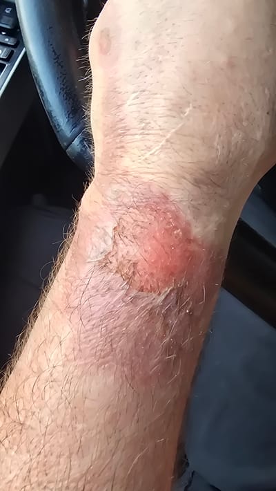 The image shows a close-up view of a person's arm with a skin irritation or burn. The skin is red and inflamed in a circular patch, with some areas appearing raw and scaly. There are also some scabs or dry patches on the inflamed skin. The surrounding skin is covered in fine hairs and appears paler in comparison. The arm is positioned over a black object that resembles a steering wheel, suggesting the person might be in a vehicle. The lighting appears to be natural, possibly from daylight, and the overall setting is indoors. No specific time of day, weather, or emotional cues are discernible. There is no visible text in the image.