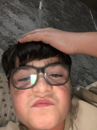The image shows a close-up portrait of a young individual, likely a child or adolescent, positioned indoors. The subject has dark brown hair and is wearing olive-green framed eyeglasses, with a rectangular light reflection visible in the left lens. Their face displays light-toned skin, prominent cheeks, and reddish marks on both cheeks. The eyes are partially closed, with the left eye appearing more constricted than the right, and the lips are pressed into a slight downturned or pursed expression. A hand, matching the subject's skin tone, is placed on top of their head, with the palm and wrist area visible. The background is a grey, textured surface, possibly a wall, exhibiting an uneven, coarse finish. In the lower left quadrant, a beige or light brown fabric patterned with light squares containing diagonal crosses is visible. In the lower right quadrant, a plain, light-colored fabric, consistent with bedding or clothing, is present. The specific location within ქვედა სამება, Georgia, cannot be determined from the visual evidence in the image.