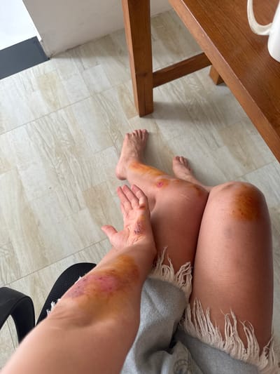 The image shows a high-angle, close-up view of a person seated indoors, focusing on their legs and one arm, which exhibit multiple injuries. The person's bare legs are visible, featuring several bruises and scrapes.
On the upper left thigh and knee area, there is a large, mottled bruise with brown and yellowish tones. A distinct reddish-pink wound or scrape is visible on the left knee itself, surrounded by yellowish-brown bruising. The lower left leg also displays areas of bruising. The person's bare feet rest on a light-colored, wood-look tiled floor.
The right leg, partially covered by a light-colored fabric with frayed edges, also shows bruising on the upper thigh. The person's right forearm and hand are extended forward, revealing a significant area of bruising and abrasion on the forearm, characterized by shades of yellow, purple, and red, indicative of different healing stages. Smaller cuts or scrapes are present on the knuckles of the right hand.
In the upper left corner, part of a light brown wooden table or desk is visible, with a white mug handle barely discernable on top. A black mesh chair backrest is seen beneath the right arm. The floor consists of light-toned tiles arranged in a plank pattern. The setting appears to be an indoor space, possibly in Thalaramba, Sri Lanka, illuminated by ambient light. No text is visible in the image.
