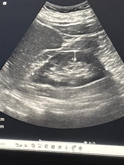 The image is a grayscale ultrasound scan. The scan shows a roughly circular structure with mixed echogenicity, suggesting a fluid-filled or complex mass. Measurement markers are visible, indicating dimensions of the structure. The image was captured in Medellín, Colombia, based on the "Em" unit and "Queda" on the display menu. No specific people, actions, or interactions can be identified from the image. The environment is limited to the ultrasound device display.