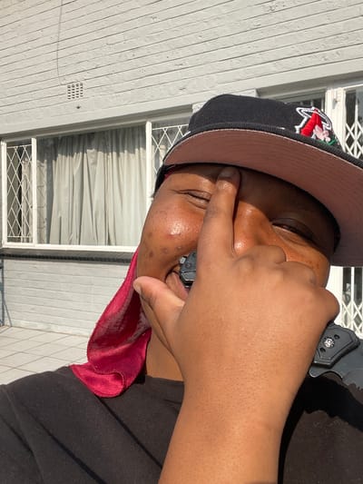 A close-up, vertically oriented, outdoor photograph shows a person's face and upper body. The subject, wearing a black baseball cap with an embroidered logo featuring red and pink flowers, has their right eye covered by their left hand. Their face is turned to the left, and their eyes are closed. The subject has dark skin with visible blemishes on their cheek and forehead. A red silk scarf is draped around their neck, with a portion of it visible on their shoulder and arm. The subject is wearing a black t-shirt. A dark object, possibly a knife or tool, is held in their right hand, near their face. The background consists of a light-colored wooden wall with horizontal slats and a window with white blinds. The lighting suggests it is daytime, with bright sunlight casting shadows. The scene appears to be in a residential area, possibly Randburg, South Africa, given the architectural style of the building and the distinctive vents on the wall. No visible text is present.