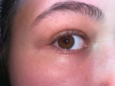 This is a close-up, eye-level shot of a person's right eye and surrounding facial area. The subject has brown eyes and dark eyebrows. The skin appears fair with some redness around the eye and cheek. The environment is not visible as the image focuses solely on the face. There is no indication of location in the city of ЖК «Борисоглебское», Russia.